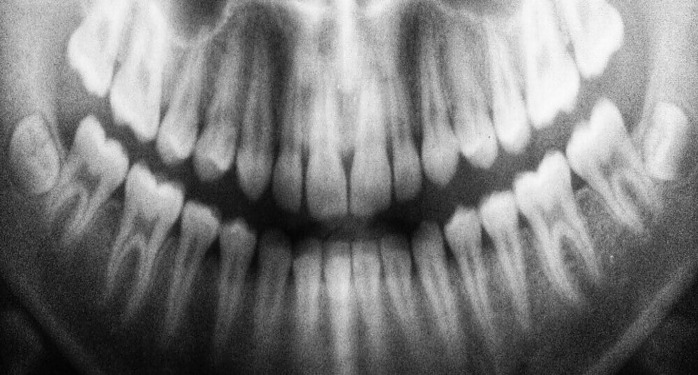 dental xray or radiograph